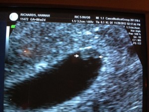 First Ultrasound...looks like a peanut but is really the size of half a grain of rice.