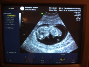 10 weeks, 2 days - kinda sorta starting to look like an actual baby...