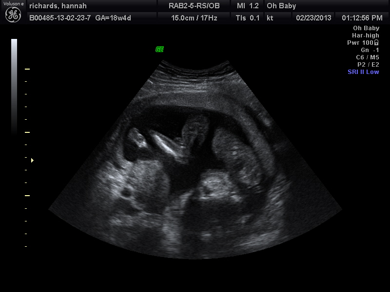 Baby Richards is all curled up in an upside-down ball.