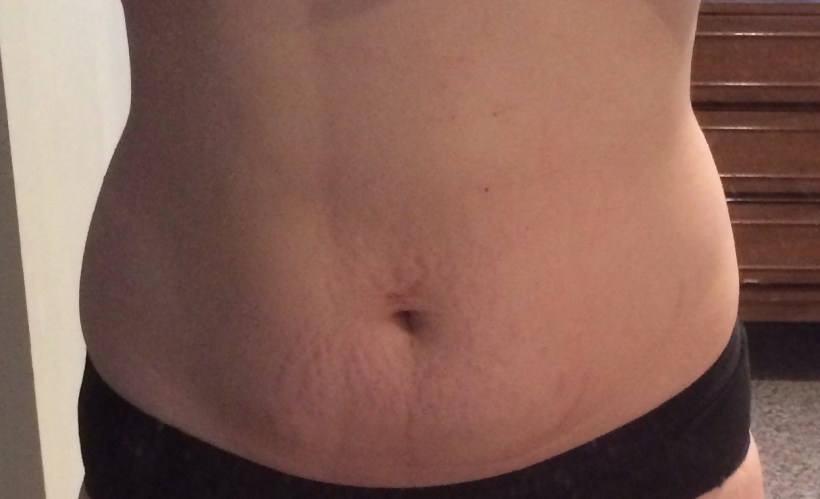 Baby Belly - 5mo post-partum
